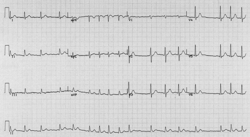 Electrocardiogram demonstrating the irregular heart rhythm Atrial Fibrillation