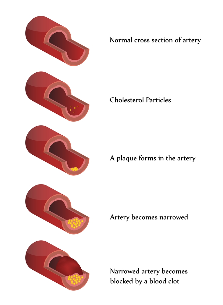 Cardiac CT scans and calcium scores