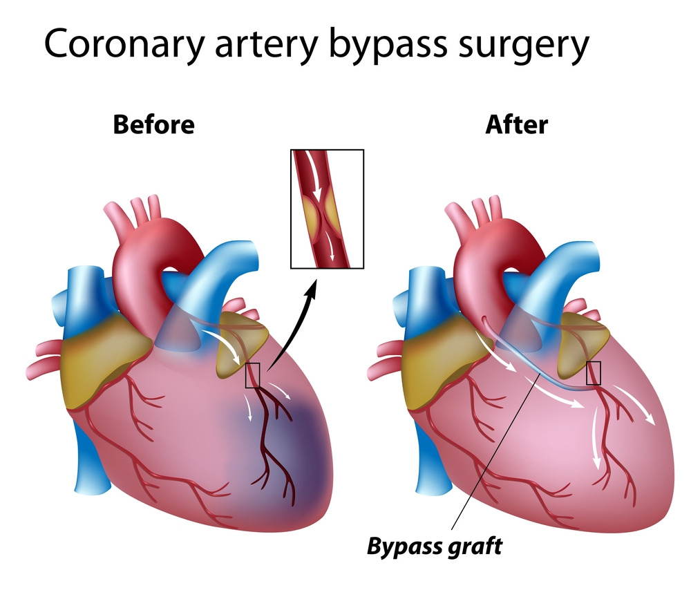 Coronary Bypass Surgery