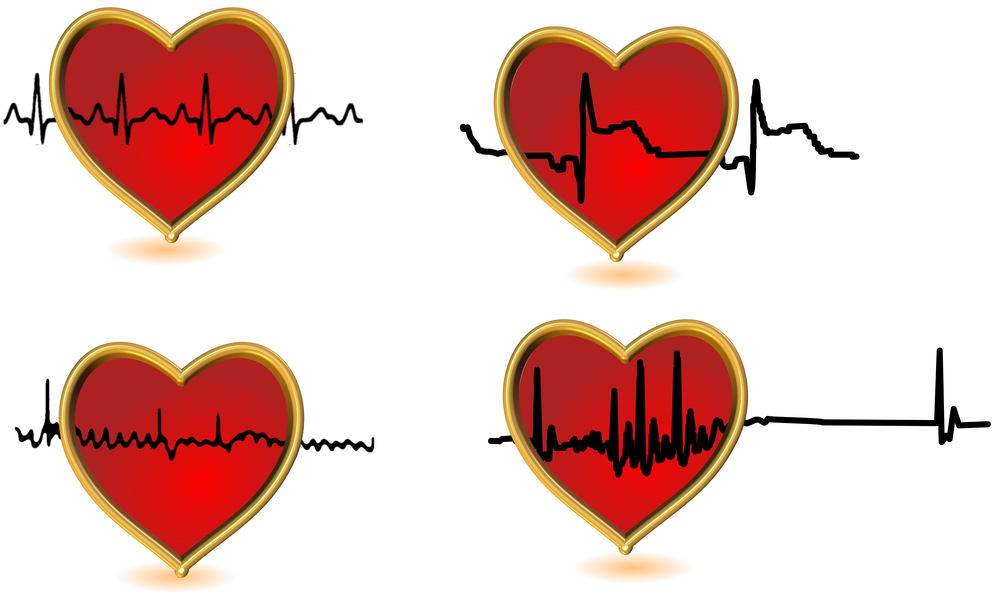 Cardiac Trigger Monitoring