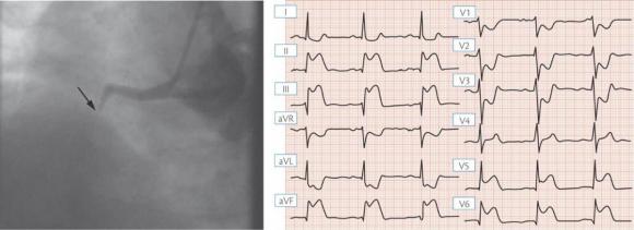 Angina and Heart Attack