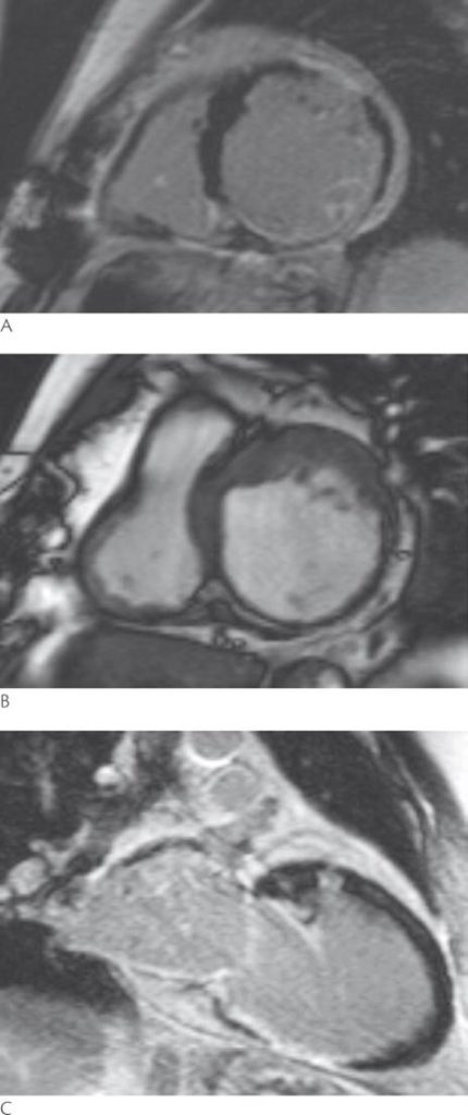 Cardiac MRI