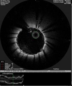 OCT Image of Coronary Stent