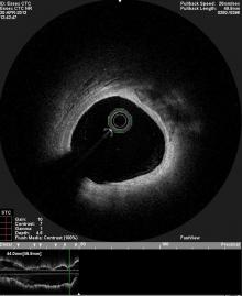 OCT image of coronary artery (above)