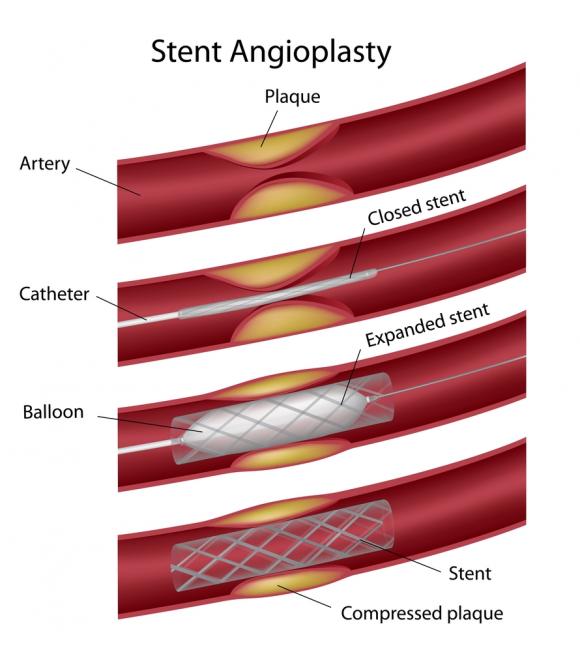 Coronary Stent Insertion and Angioplasty