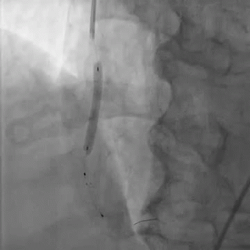 Placement of Stent in vein graft