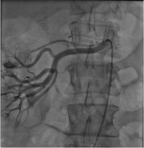 Selective Angiogram of Renal Artery